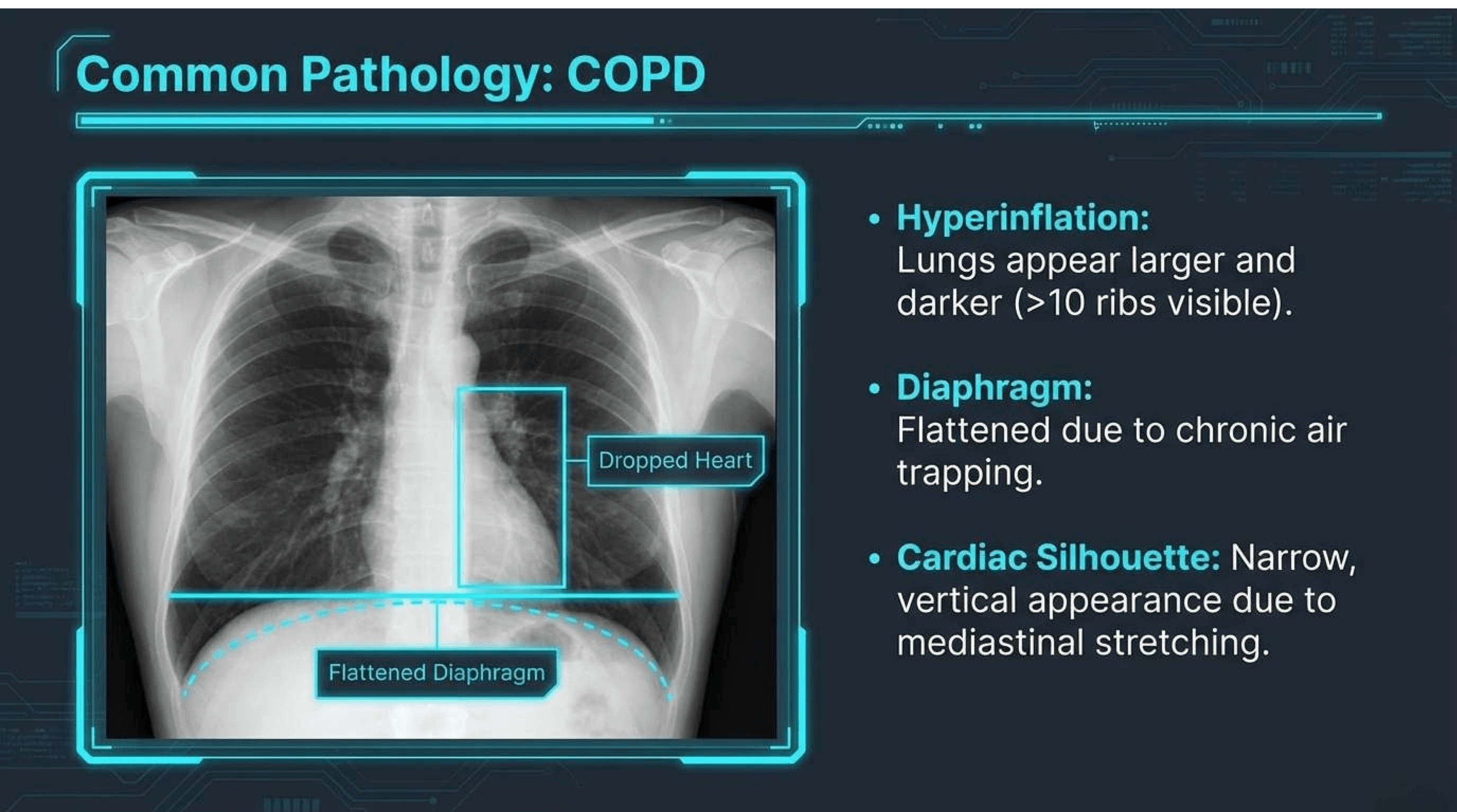 Slide 14 of CXR Interpretation: Reading Between the Ribs
