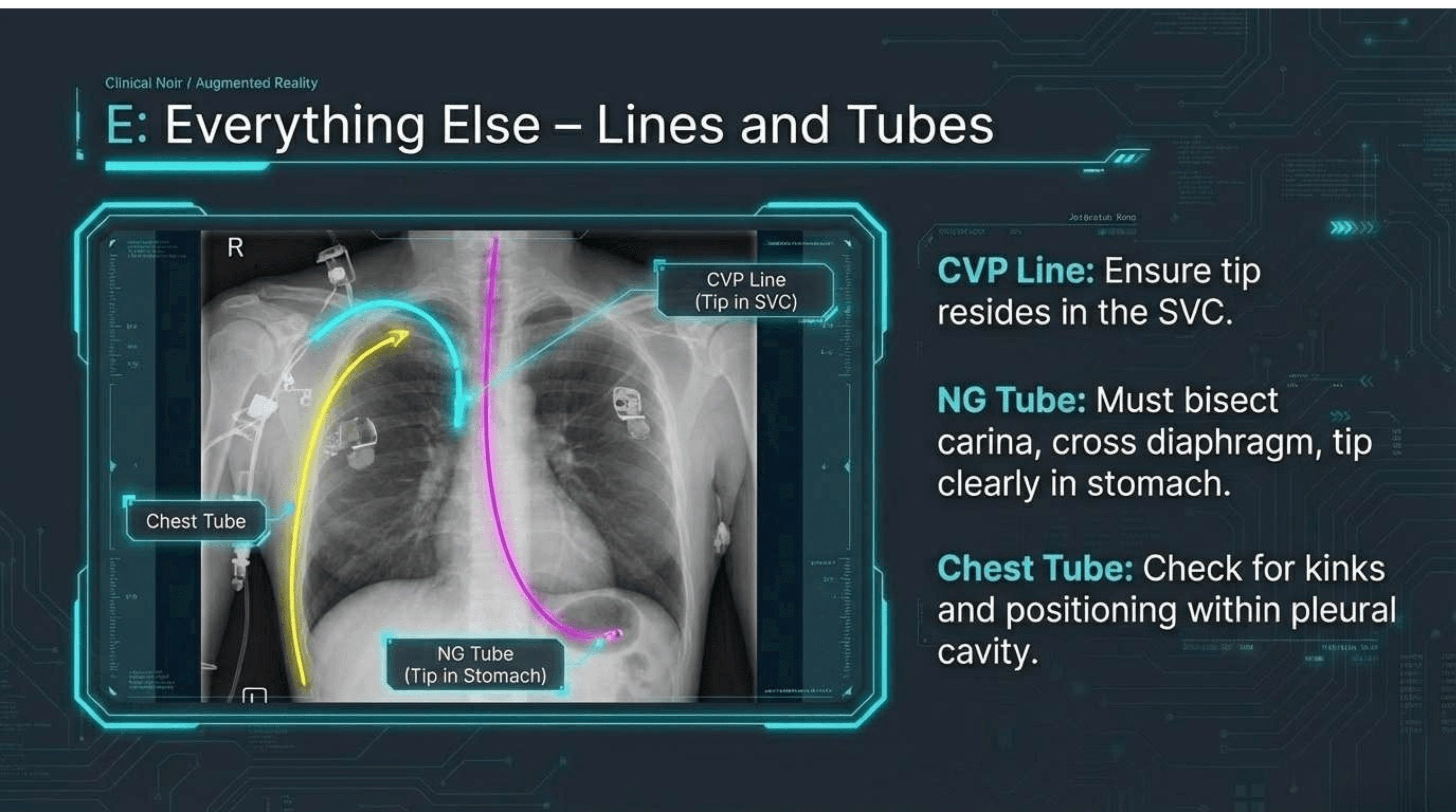 Slide 12 of CXR Interpretation: Reading Between the Ribs